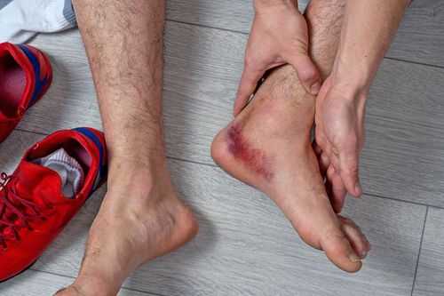 Image is of a man holding his injured ankle with bruising, concept of foot and ankle pain treatment in Chicago
