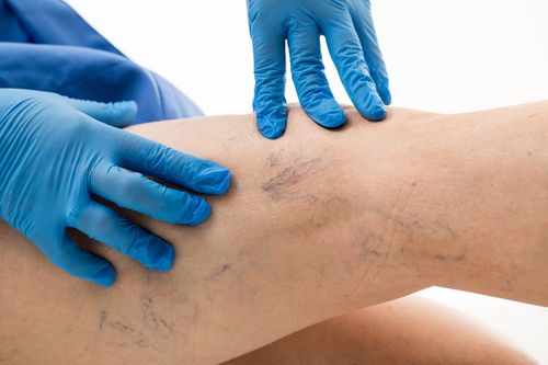 Image is of a physician examining the leg of a patient with spider veins concept of spider and varicose vein treatment in Chicago