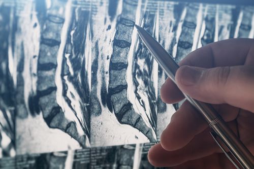 Image is of a doctor examining an mri image of a lumbar spine concept of Woodridge injury treatment center